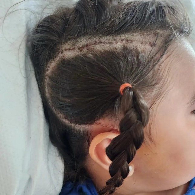 Kỳ diệu phương pháp điều trị viêm não cho bé gái 6 tuổi - Ảnh 1.