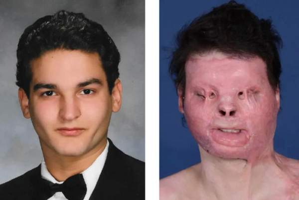 Người đầu tiên trên thế giới được phẫu thuật ghép mặt: Cuộc sống thay đổi "thần kỳ" sau 3 năm! 1